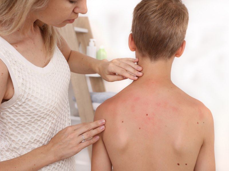 How Cleanliness and Exposure Shape Allergy Risk